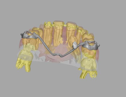 TPA (Trans-Palatal Arch)
